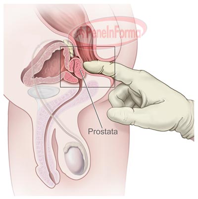 prostat